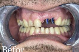 دندانپزشکی -ایمپلنت و لمینیت تخصصی 