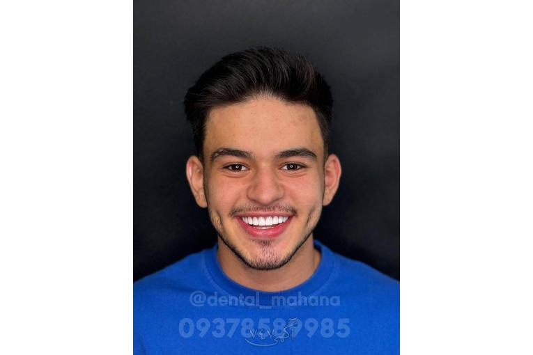 کامپوزیت دندان ایمپلنت لمینت عصب کشی کلینیک ماهانا