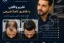 پروتز مو مردانه اصفهان | نصب فوری پروتز طبیعی و VIP>