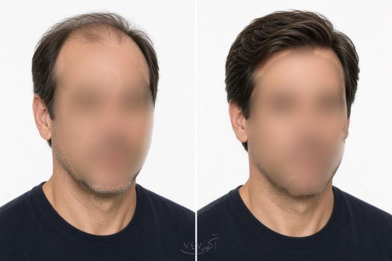 پروتز موی طبیعی جایگزین کاشت مو 