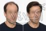 پروتز موی طبیعی جایگزین کاشت مو >