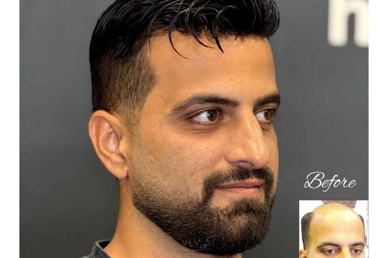 پروتز موی طبیعی جایگزین کاشت مو 